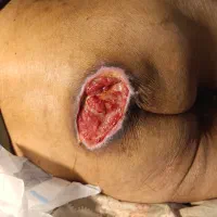 درمان نوین انواع زخم دیابتیک و بستر و جراحی و بخیه|خدمات آرایشگری و زیبایی|صومعهسرا, |دیوار