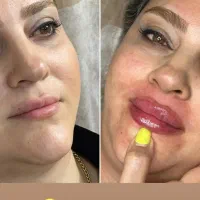 بمب تخفیف خدمات زیبایی ژل بوتاکس جوانساز بادی|خدمات آرایشگری و زیبایی|اهر, |دیوار