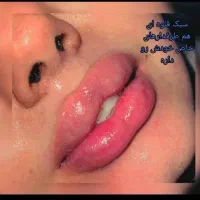 تزریق ژل بوتاکس چربی