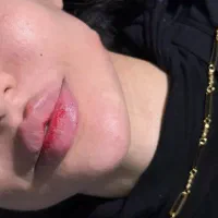 تزریق فول فیس صورت