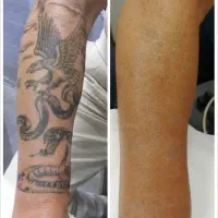 پاک کردن تتو،بلفاروپلاستی،لیزرموهای زائد،درشهرری