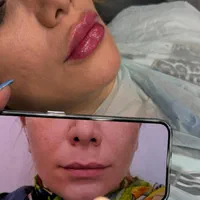 مطب تزریق ژل لب روسی فیلر بوتاکس مزوتراپی مزوژل