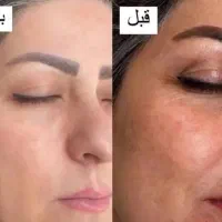 پک صابون و سرم شیر الاغ برطرف کننده لک و جوش صورت|آرایشی، بهداشتی، درمانی|زابل, |دیوار