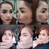 لیزرco2تک جلسه ای،تزریق چربی، دیگر خدمات زیبایی|خدمات آرایشگری و زیبایی|دهدشت, |دیوار