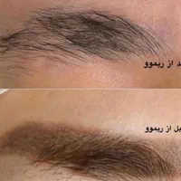 ریموو تتو با اشانتیون  در کلینیک زیبایی|خدمات آرایشگری و زیبایی|تهران, تهرانپارس غربی|دیوار
