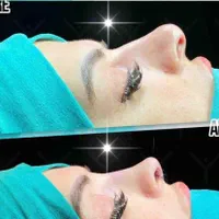 عمل بینی (پیکر تراشی تخصصی) لیپو لیفت پروتز سینه|خدمات آرایشگری و زیبایی|تهران, تهرانپارس غربی|دیوار