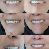 پروتز دندان (دندان مصنوعی)|خدمات آرایشگری و زیبایی|تربت‌حیدریه, بازار|دیوار