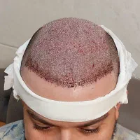 کاشت مو و ابرو در شهر شیراز