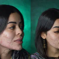 پکیج فول فیس (زاویه فک/فیلر/شقیقه)