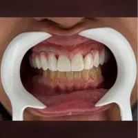پروتز کامل و دندان مصنوعی|خدمات آرایشگری و زیبایی|تهران, پرستار|دیوار