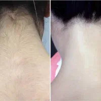 اف ویژه لیزر موهای زائد فقط تا پایان این ماه