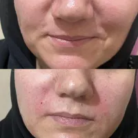 ژل و‌ بوتاکس