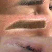 تاتو و ریمووتخصصی صورت با ۵۰٪ درصد