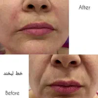 تخفیفات خدمات فیلر و بوتاکس کلینیک|خدمات آرایشگری و زیبایی|شاهین‌شهر, فردوسی|دیوار