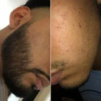 ریش پرپشت، سریع‌تر از تصور