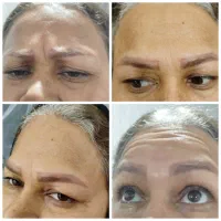 ژل و بوتاکس در منزل شما