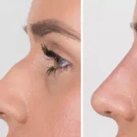 نیازمند مدل فیلر