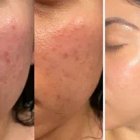 نیازمند دو مدل جهت انجام اسیدتراپی هستیم