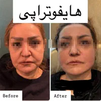 هایفوتراپی جوانسازی آف ویژه|خدمات آرایشگری و زیبایی|قم, شهرک قدس|دیوار