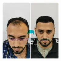 کاشت مو تخصصی|خدمات آرایشگری و زیبایی|پارس‌آباد, |دیوار