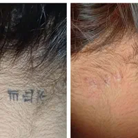 پاک کردن تتو///خدمات لیزر کیوسوئیچ و پیلینگ کربن|خدمات آرایشگری و زیبایی|صدرا-فارس, فاز ۱|دیوار