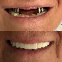 دندانپزشکی و شرایط اقساطی بدون بهره ایمپلنت|خدمات آرایشگری و زیبایی|تبریز, |دیوار