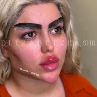 تزریق تخصصی ژل لب-فیلربینی وآنزیم بوتاکس ضمانتی