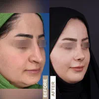 جراحی بینی ابدوساکشن بلفارو(پلک)غبغب تیپ پلاستی|خدمات آرایشگری و زیبایی|مشهد, احمدآباد|دیوار