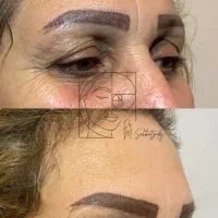 بوتاکس و فیلر صورت برای مدل تحت نظر پزشک|خدمات آرایشگری و زیبایی|زنجان, |دیوار