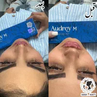تزریق و اموزش ژل بوتاکس بادی هیپ دیپ