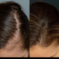 مزو تراپی موی سر مزوتراپی مو
