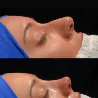 آخرین تابستانه و تخفیفات عمل بینی تا آخر شهریور|خدمات آرایشگری و زیبایی|تهران, فلسطین (میدان انقلاب)|دیوار
