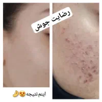 لاغری ،کاهش اشتها پاکسازی کبد، کیست و تنبلی تخمدان|آرایشی، بهداشتی، درمانی|تهران, یوسف‌آباد|دیوار