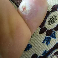 برداشتن خال زیگیل ومیخچه دست پابامحلول گیاهی|خدمات آرایشگری و زیبایی|نیشابور, بنیاد شهید|دیوار