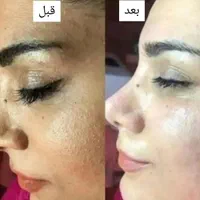 کرم درمان لکه و کک و مک و....|آرایشی، بهداشتی، درمانی|میاندوآب, |دیوار