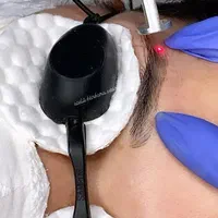 پاک کردن تتو ابرو و بدن با دستگاه لیزر پیکوشور