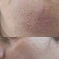 فیشیال درمانی تک جلسه ای|خدمات آرایشگری و زیبایی|مشهد, کشف|دیوار