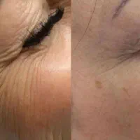 بوتاکس ژل لب گونه چانه فک پر کردن صورت لاغر نخ مزو|خدمات آرایشگری و زیبایی|قم, زنبیل آباد|دیوار