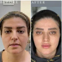 هایفو و جوانسازی پوست ویژه جشنواره یلدا ۸۹۰ت|خدمات آرایشگری و زیبایی|اصفهان, پروین|دیوار