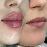 تزریق ژل و بوتاکس جشنواره عید|خدمات آرایشگری و زیبایی|تهران, عبدل‌آباد|دیوار