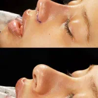 عمل جراحی بینی،لیفت صورت،اندام،گوش