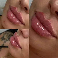 تزریق ژل و چربی، بوتاکس،هایفو