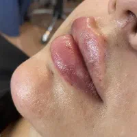 فیلربینی۱۲۰۰ لب۸۰۰ بوتاکس۶۵۰