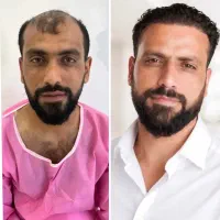 کاشت مو و ابرو اقساط تیم شیرازی در سنندج