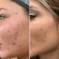 پاکسازی و جوانسازی تخصصی پوست