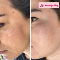 لیزر کک مک خال لیفت لمینت پاکسازی مژه ناخن ژل|خدمات آرایشگری و زیبایی|خرم‌آباد, |دیوار