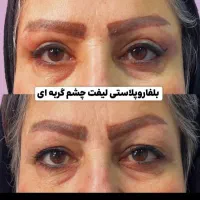 بلفاروپلاستی توسط پزشک