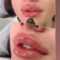 تخفیفات پاییزه   ژل ، بوتاکس ، فیلر،جوانسازی پوست|خدمات آرایشگری و زیبایی|تهران, نیروی هوایی (پیروزی)|دیوار