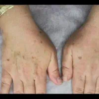 کوچک کردن بینی.رفع افتادگی‌پلک و چروک صورت|خدمات آرایشگری و زیبایی|زاهدان, |دیوار