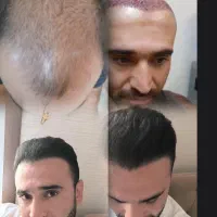 کاشت مو و زیبایی